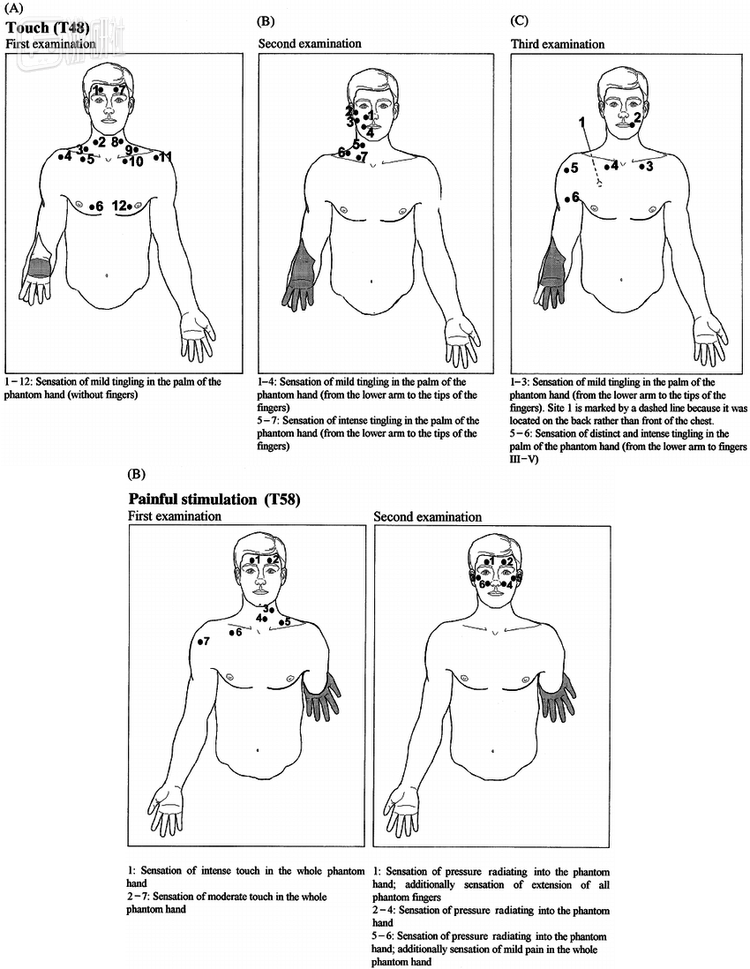 患肢痛：截肢患者感到自己失去的肢体发生错位，并且隐隐作痛