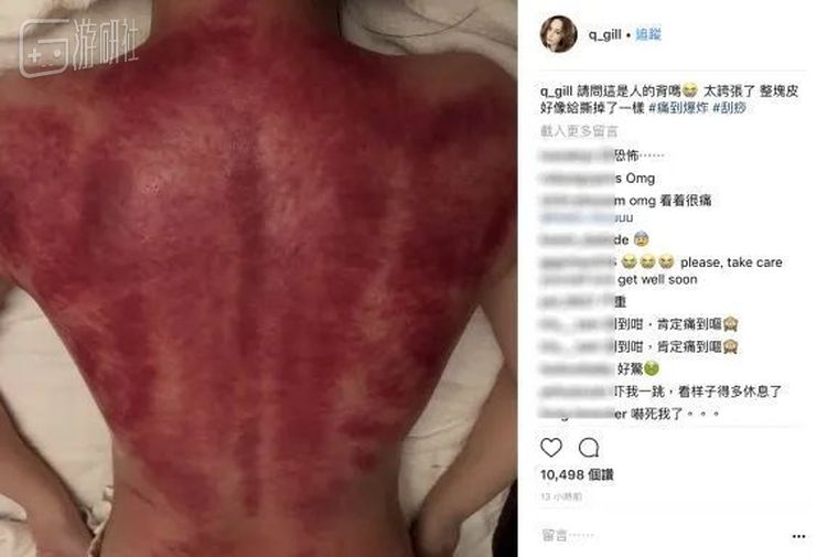 阿娇刮痧后的状态